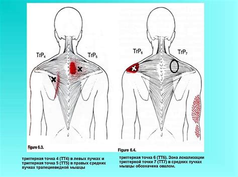 Болевые ощущения при нажимании на точки триггерные зоны