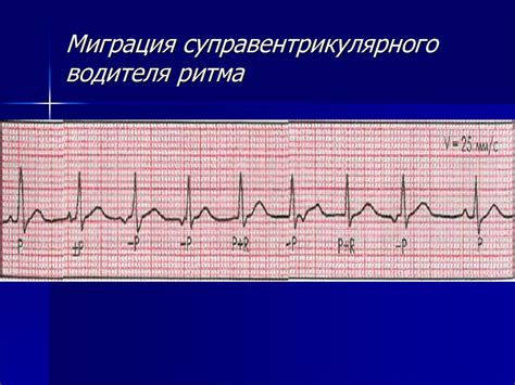 Причины синусового нерегулярного ритма у ребенка